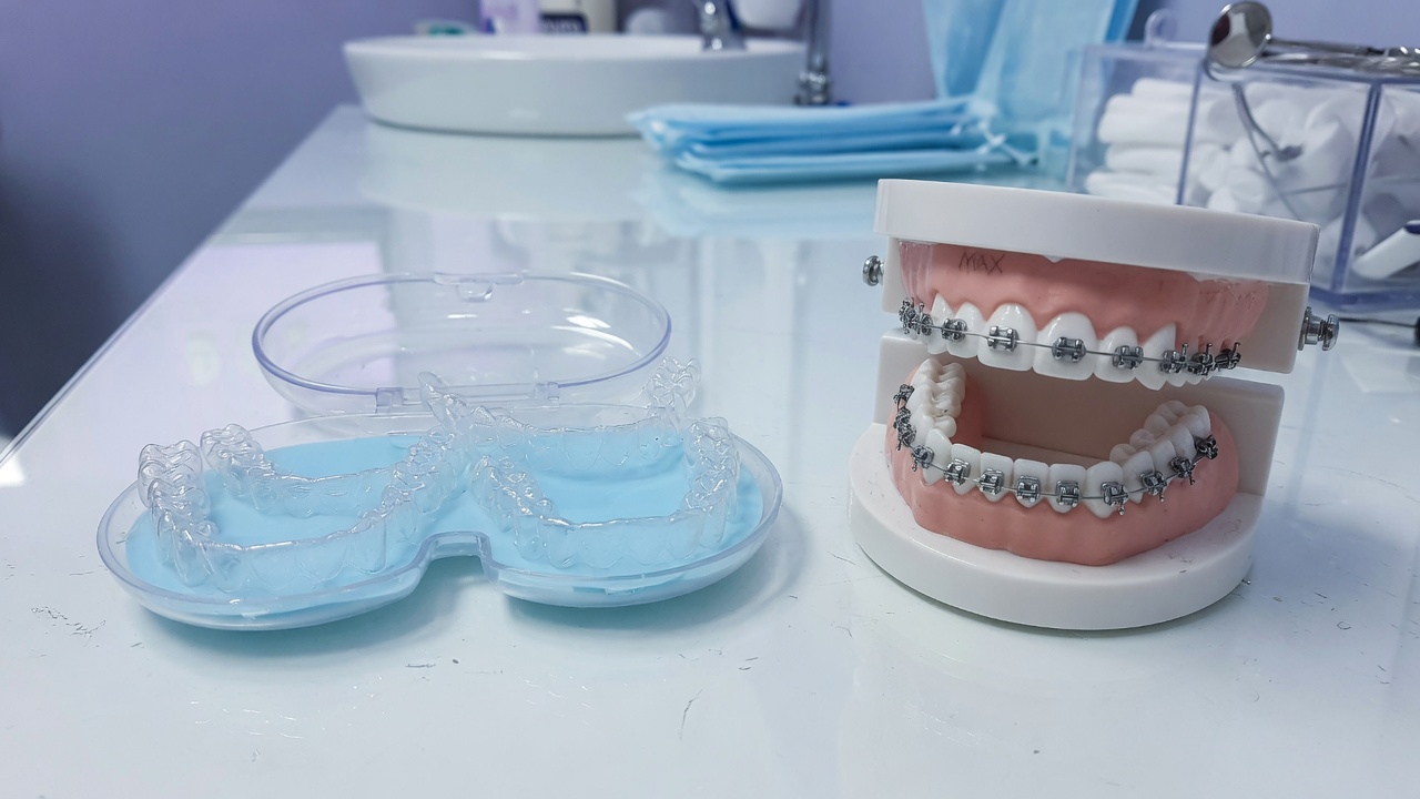 Comparaison entre gouttières transparentes et appareil lingual sur modèle dentaire