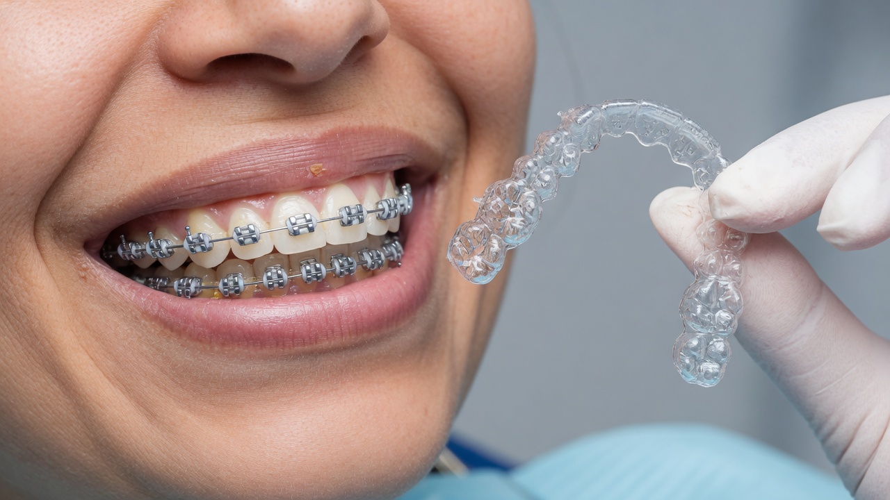Bagues dentaires ou gouttières transparentes : comment trancher ?