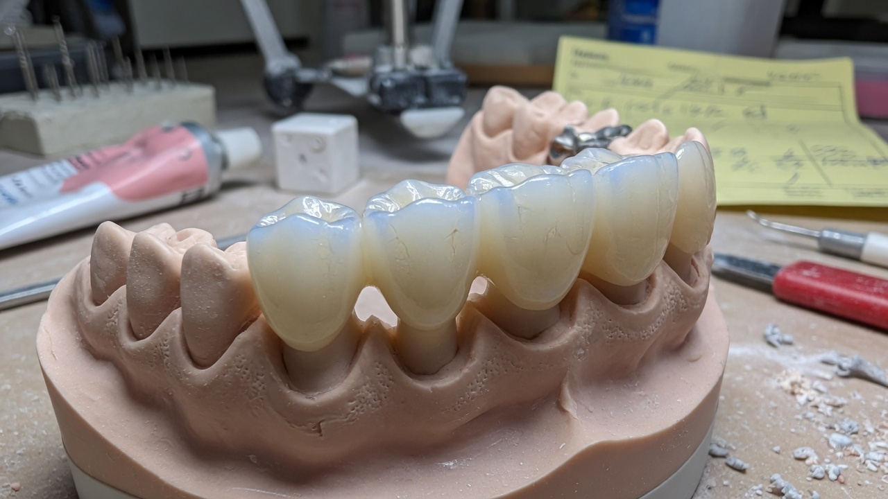 Bridge dentaire antérieur tout céramique sur modèle de laboratoire