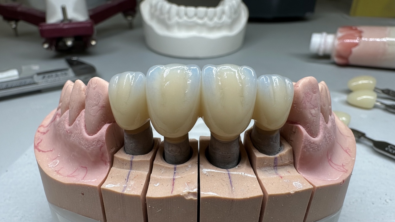 Bridge dentaire dent devant : options, esthétique et coûts