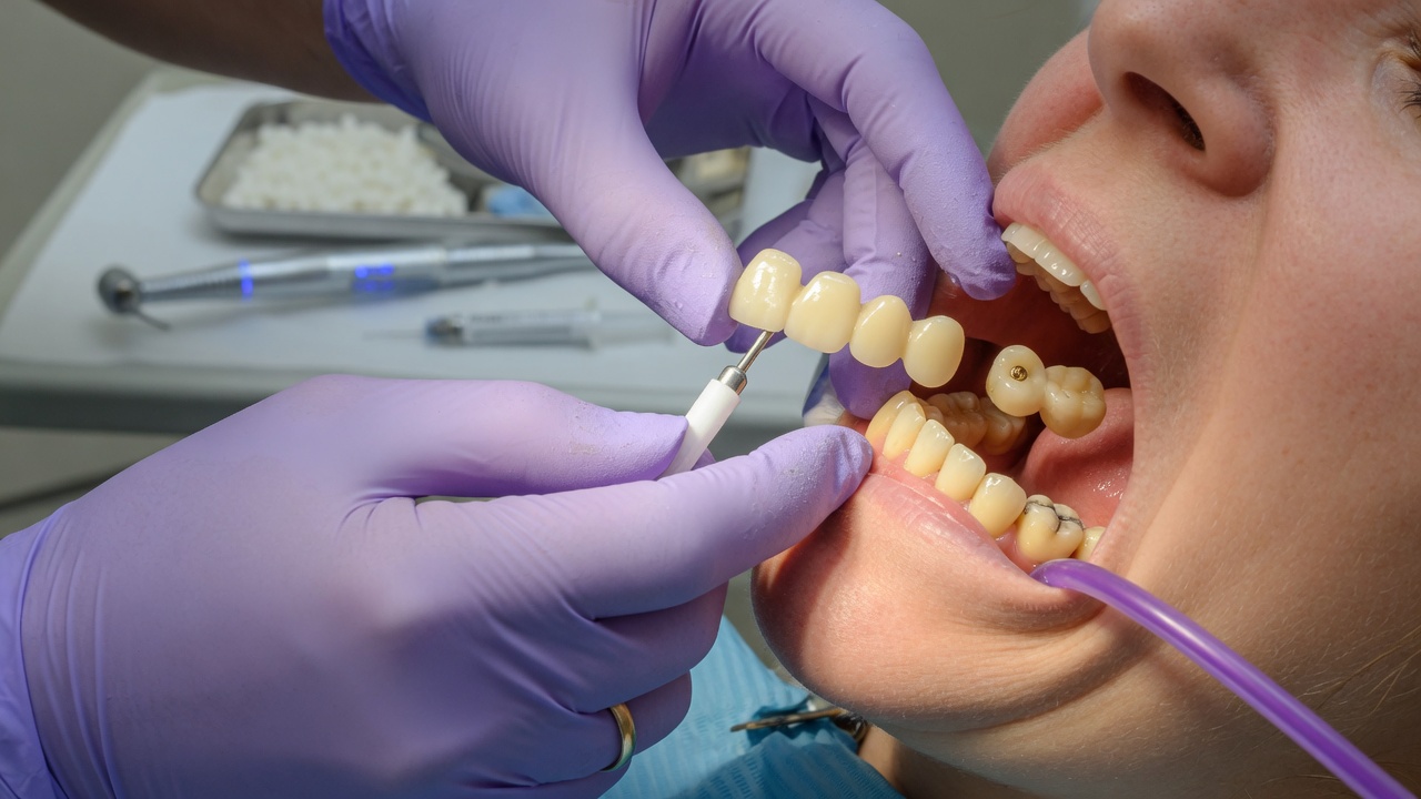 Pose d’un bridge dentaire en cabinet pour remplacer une dent manquante