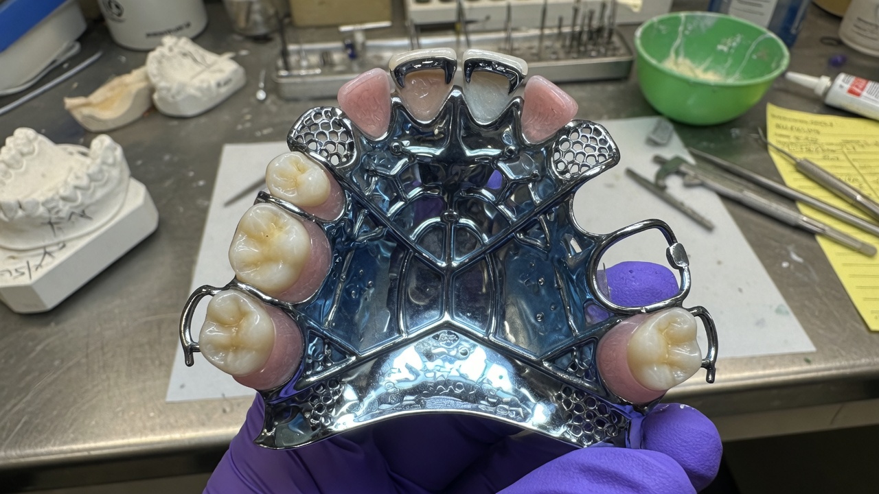 Dentier avec palais métal : avantages, inconvénients, prix et entretien