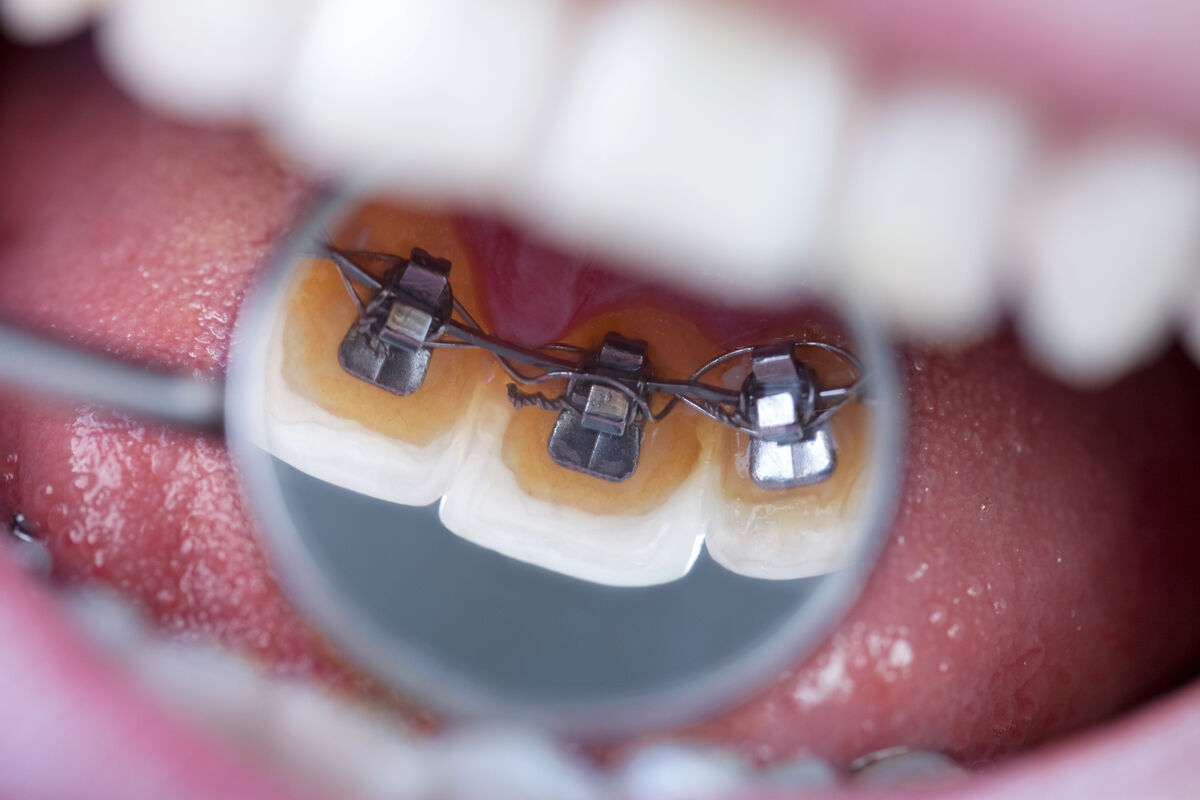 Appareils dentaires invisibles : Invisalign vs Orthodontie Linguale