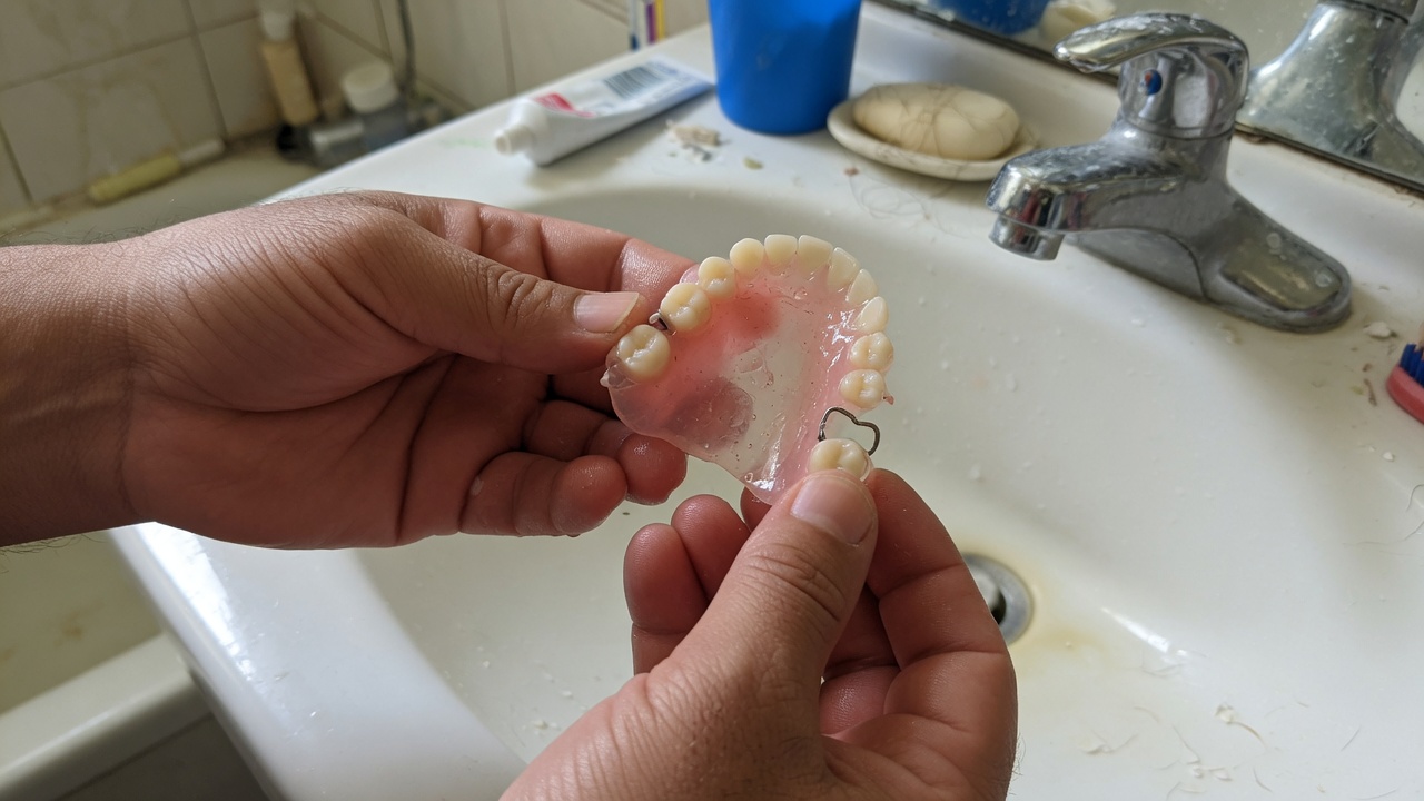 Prothèse amovible provisoire : tenir le sourire en attendant l’appareil définitif