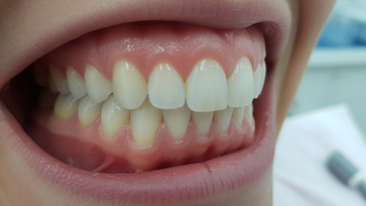 Instruments de surfaçage et ultrasons le long de la ligne gingivale